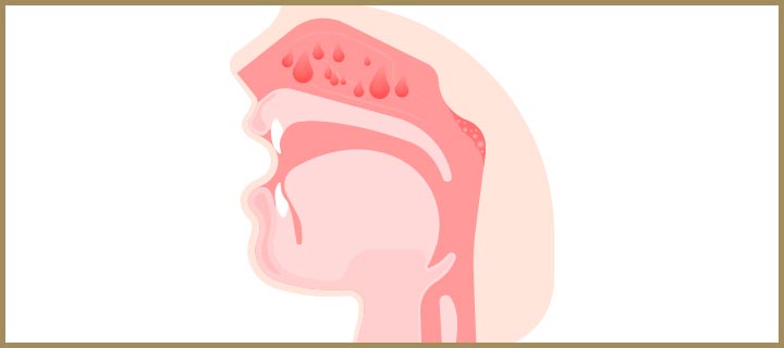 nasal-polyps-treatment-specialist