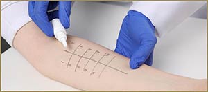 Patch Testing for Contact Dermatitis Near Me in Suffern, NY and Monroe, NY